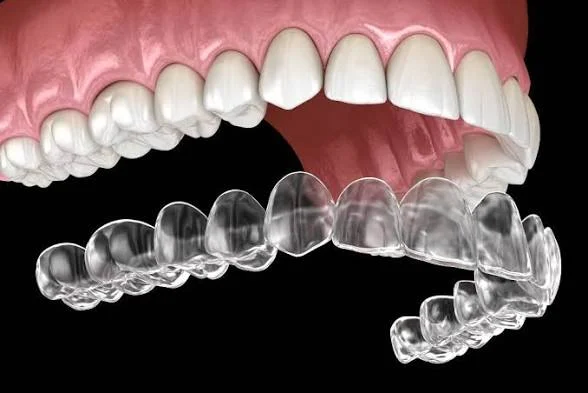 Clear dental aligner positioned in front of upper and lower teeth