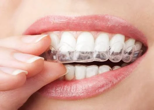 Adult placing a clear Invisalign aligner over the upper teeth