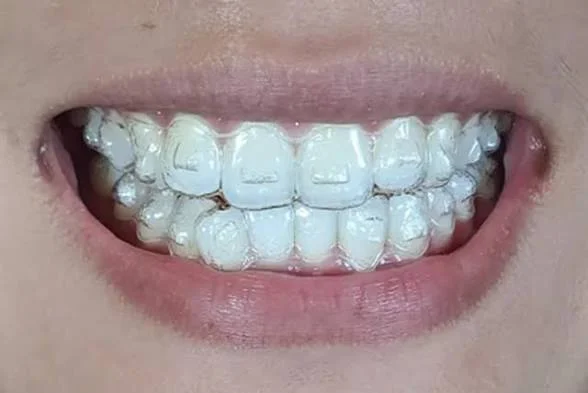 Invisalign clear aligners fitted over teeth with attachment shapes