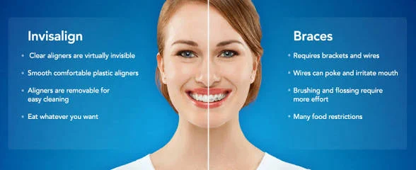 Illustration comparing Invisalign clear aligners with fixed braces